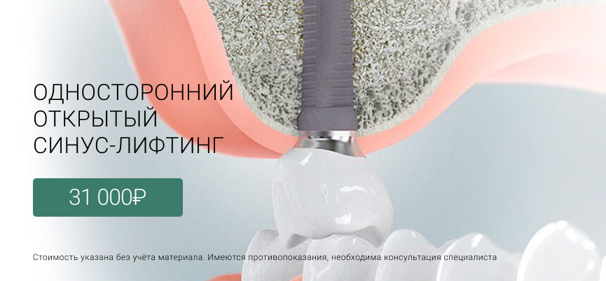 Синуслифтинг открытый Лиговский проспект 228, Маршала Казакова 72